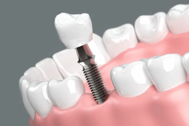 インプラント治療で歯がない期間はある？その期間と対応方法を紹介